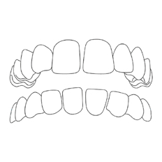 gapped teeth