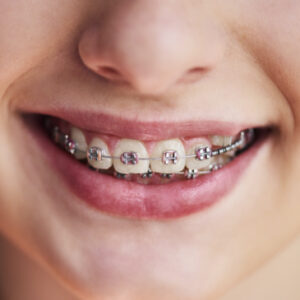 Children's braces