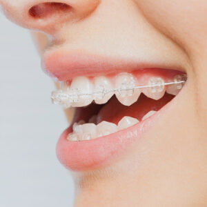 Cosmetic braces