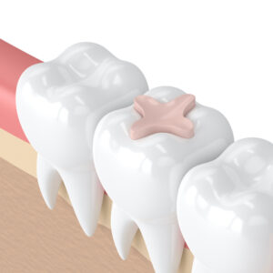 Tooth repair demo