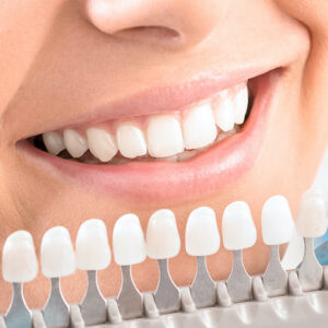 Teeth whitening