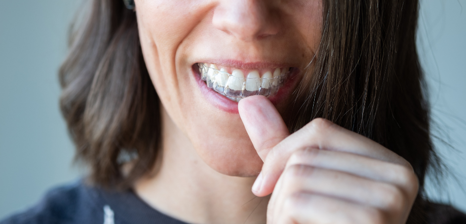 close up image focusing on a woman's teeth where she is pushing a clear aligner over the top set of her teeth with her thumb