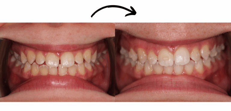Case Study – Invisalign and composite veneers transformation