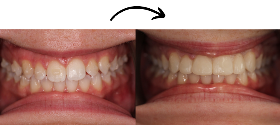 before and after image of a patient after cosmetic dental treatment, showcasing the direct transformation 