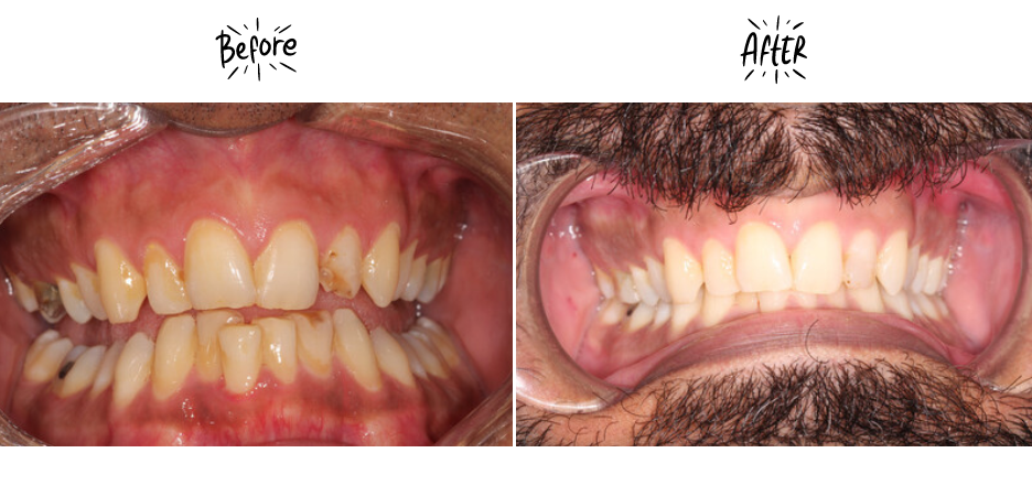 teeth whitening before and after