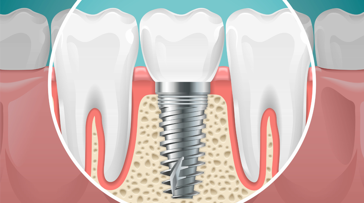 Diagram of the interior of a dental implant screw