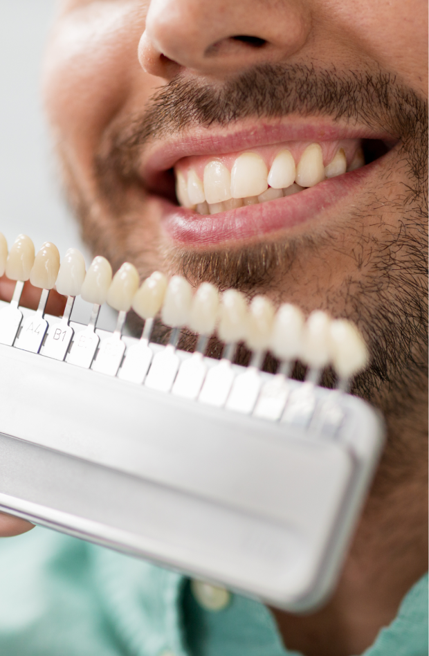 Veneers
